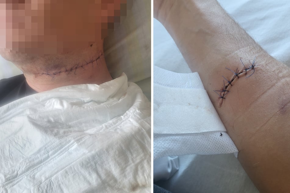 Der Hals des 37-jährigen Deutschen zeigt schlimme Verletzungen. Auch der Arm musste mit mehreren Stichen genäht werden.