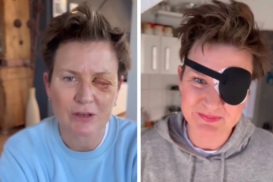 Andrea Plewigs (55) Auge musste operiert werden, doch draußen trägt sie momentan noch eine Augenklappe.