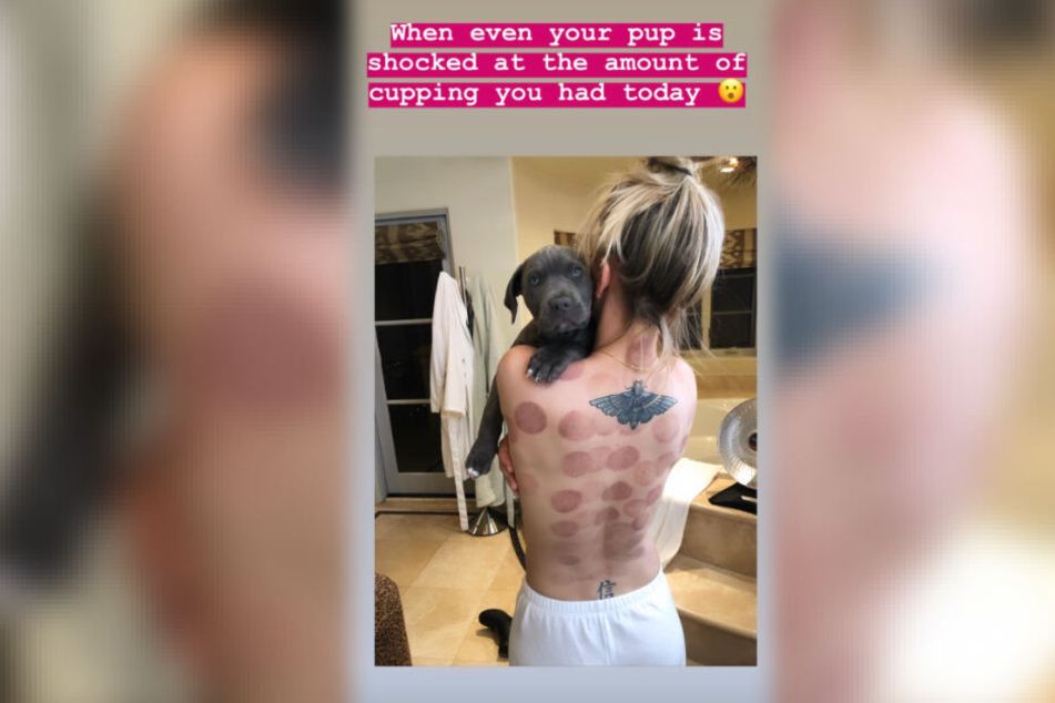 Schauspielerin Kaley Cuoco setzt ganz offensichtlich zur Entspannung auf die Heilmethode des Schröpfens.
