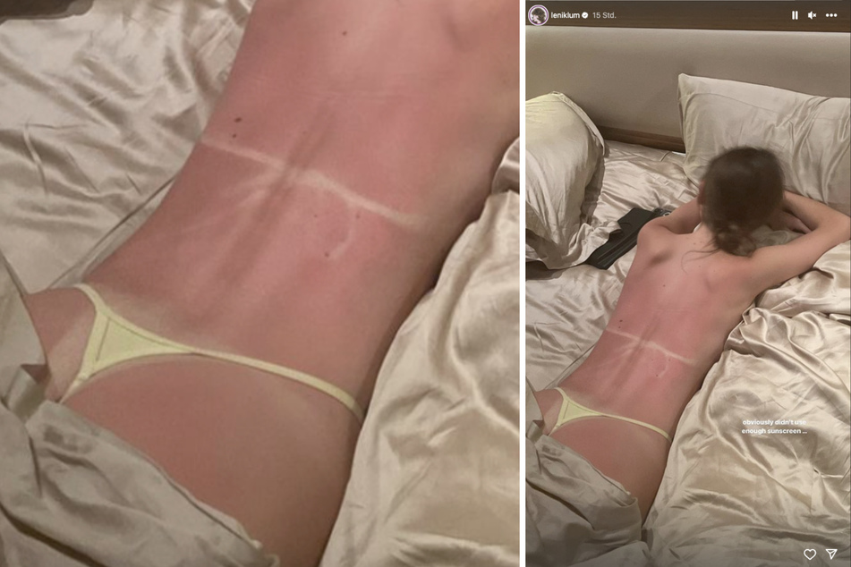 Leni Klum (19) zeigt auf Instagram ihren verbrannten Rücken.
