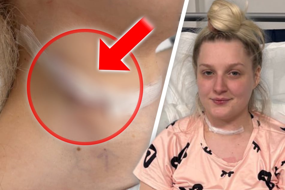 Junge Frau hielt Wölbung für Adamsapfel: Beule am Hals sorgt für Schockdiagnose