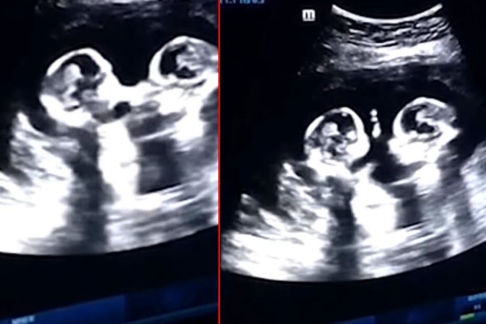 Während der Ultraschall-Untersuchung sah man die Zwillingsschwestern offenbar gegeneinander kämpfen.