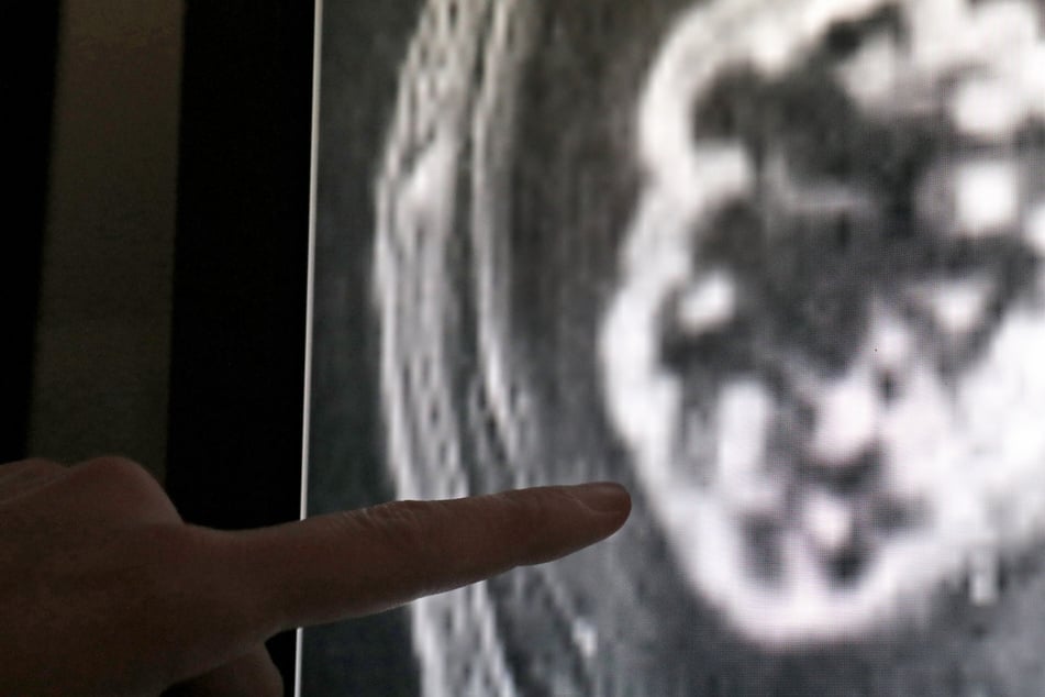 Sachsen-Anhalt už není negativním špičkovým lídrem: méně lidí umírá na rakovinu