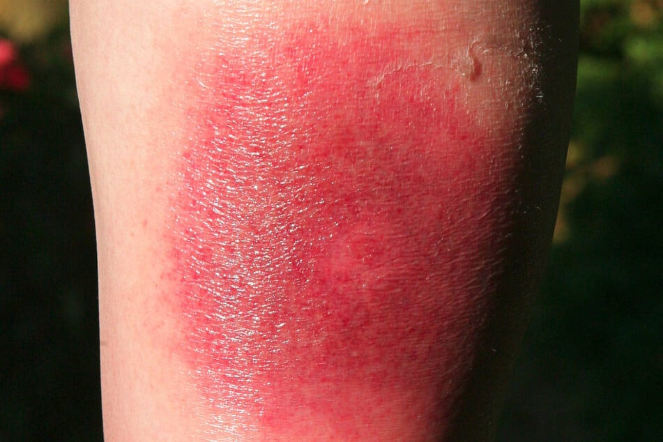 Wanderröte und Schwellungen können nach einem Zeckenstich auf Borreliose hindeuten.