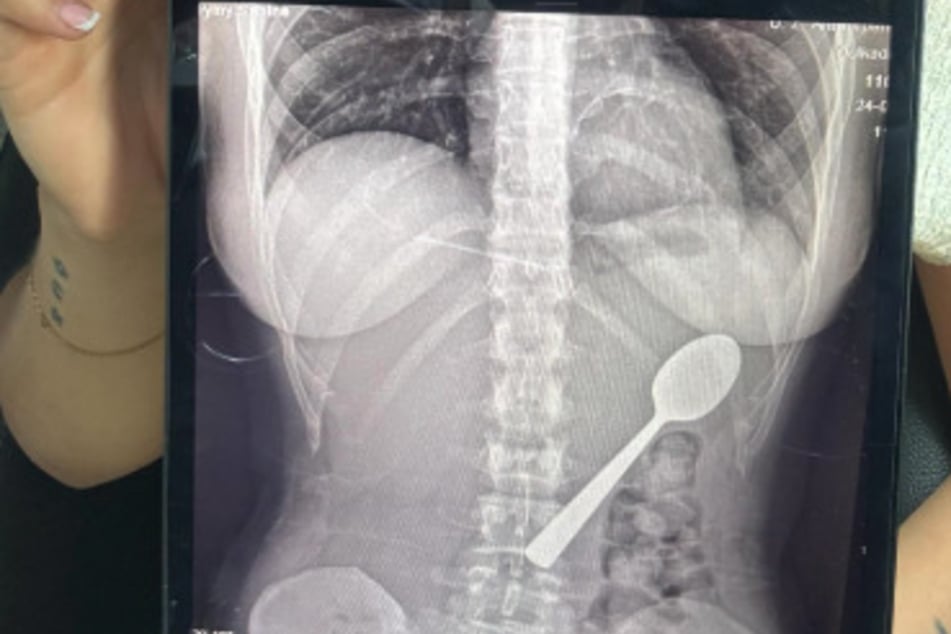 Auf Instagram präsentierte Reymy Amelinckx (28) ihr Röntgenbild.