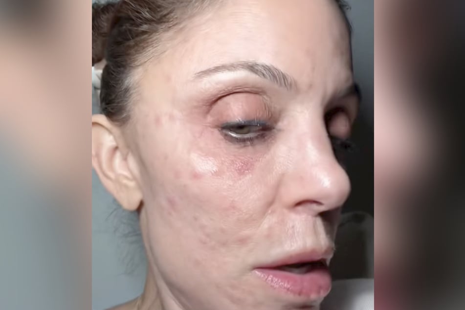 Die roten Flecken im Gesicht verhagelten der 55-Jährigen den Jahreswechsel in der Karibik.