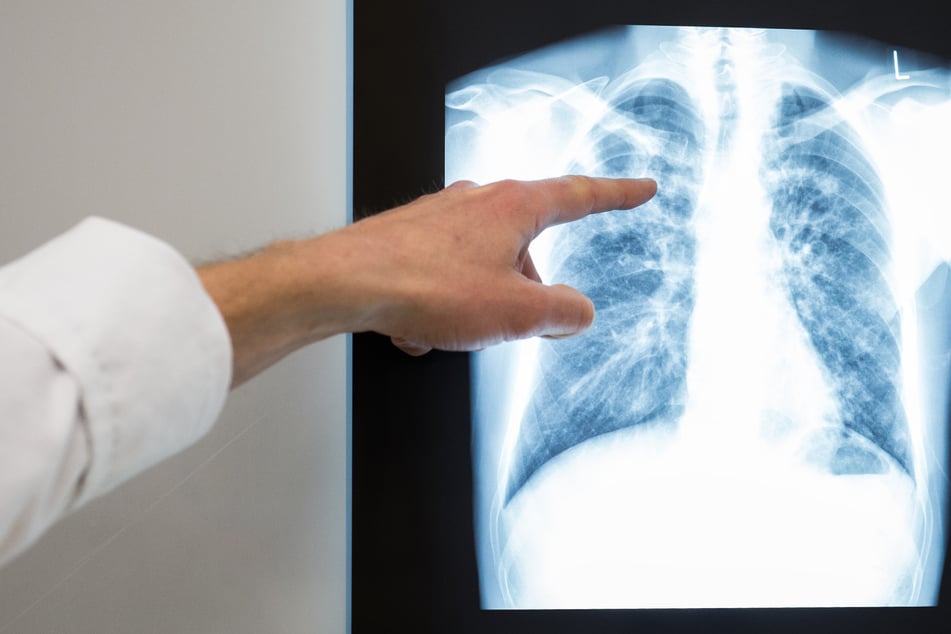 Das Röntgenbild der Lunge gibt Aufschluss über eine mögliche Tuberkulose-Erkrankung. (Symbolbild)