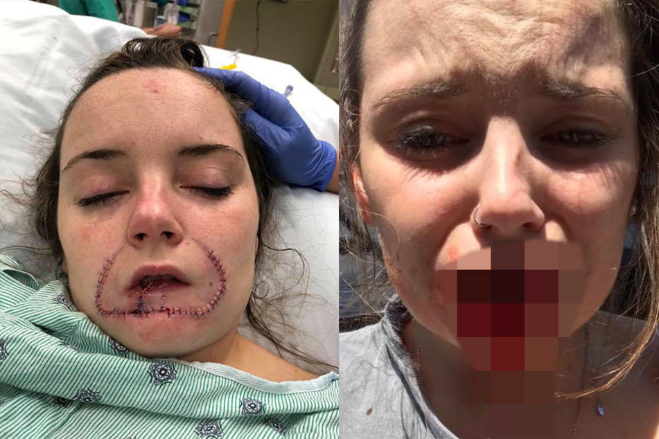 Kayla Hayes liegt mit einer riesigen Narbe im Krankenhaus (links), die sie von einer schrecklichen Verletzung durch ihren Ex-Freund bekam.