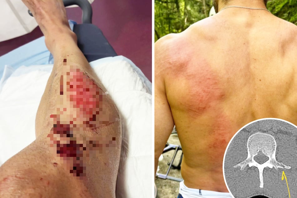 Horror-Sturz mit dem Rennrad: Biathlon-Star erleidet schwere Verletzungen