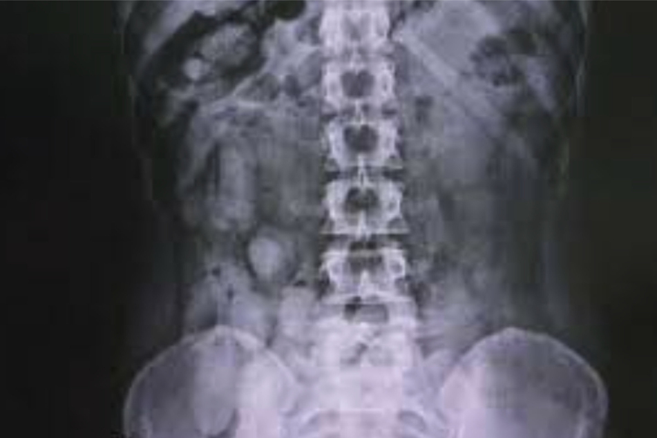 An X-ray shared by police revealed the women had drugs hidden within their bodies.