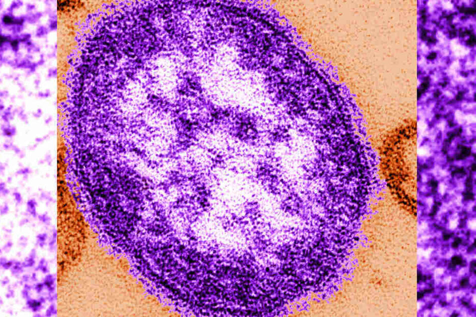 Der Masernvirus abgebildet durch ein Transmissionselektronenmikroskop.