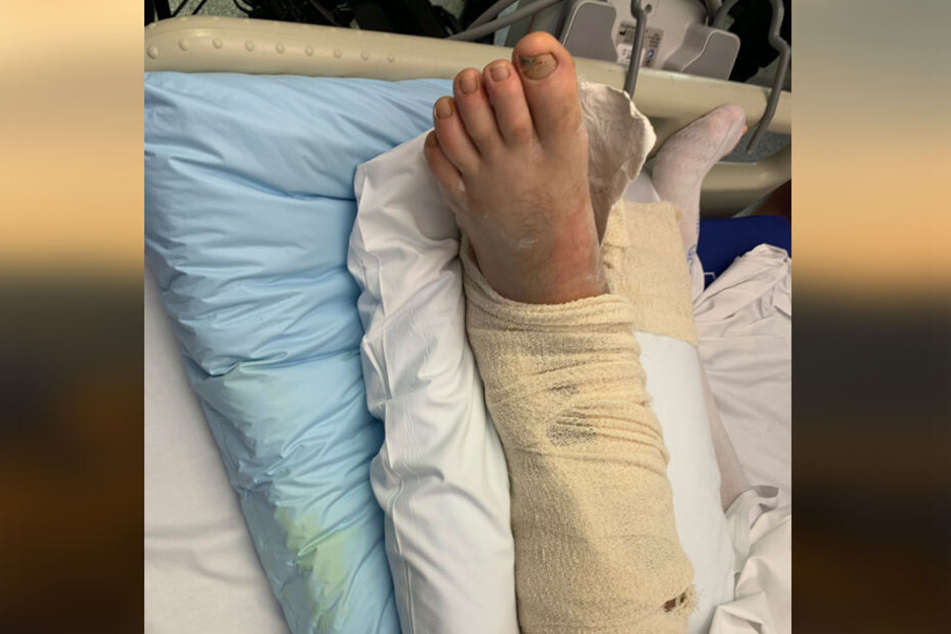 Neil Parkers Bein sieht nach der Tortour sehr mitgenommen aus.