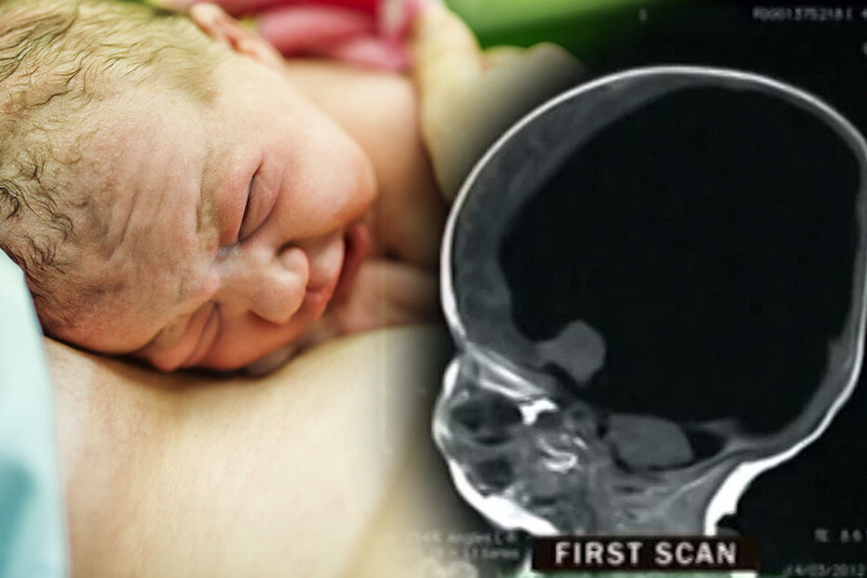 Ärzte rieten Mutter fünfmal, ihre Schwangerschaft abzubrechen: Baby wird "ohne Gehirn" geboren