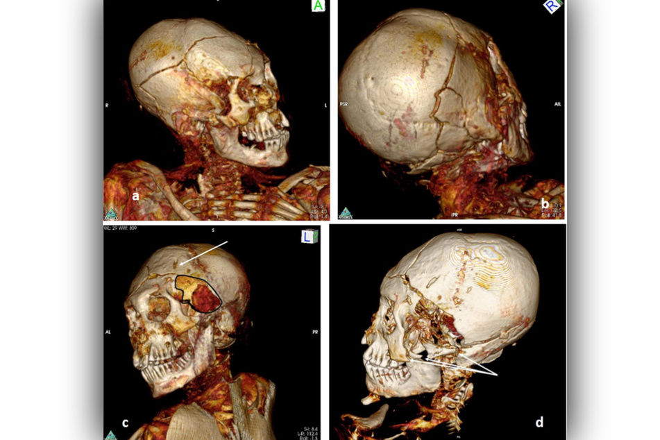 3D-CT-Scan des Schädels der männlichen Mumie aus Délémont. (a-d): Merkmale eines Schädeltraumas auf der linken Seite des Schädels mit einer großen Läsion im linken Schläfenbereich (Pfeil) und einer in den Schädel verlaufenden Fraktur. (d) zeigt den Bruch des Jochbeins auf der linken Seite (Pfeile).