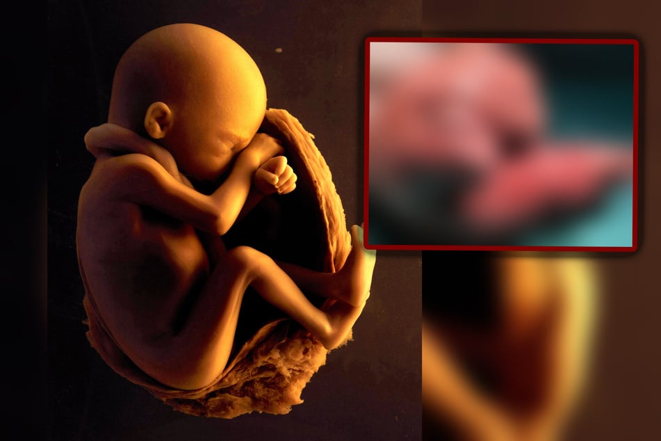 Schockierende Bilder: Ungeborener Zwilling aus Gehirn von Einjähriger entfernt!