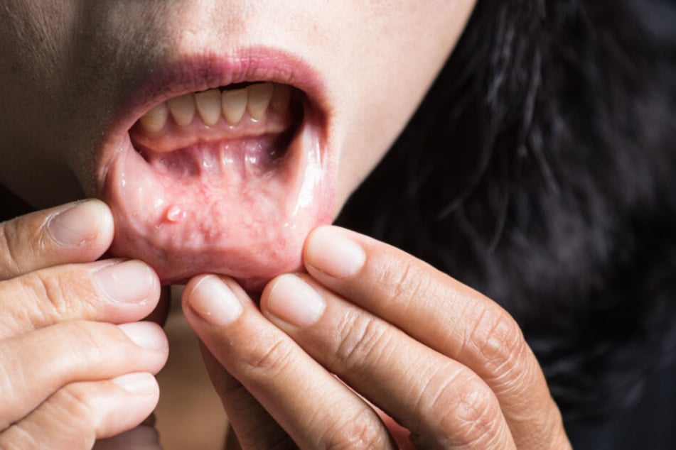 Weiße Pickel und Flecken im Mundbereich können ein Anzeichen für Mundkrebs sein.