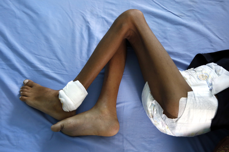 Ein unterernährtes Kind liegt in einem Krankenhaus. Der Krieg im Jemen wird als derzeit größte humanitäre Katastrophe weltweit bezeichnet.