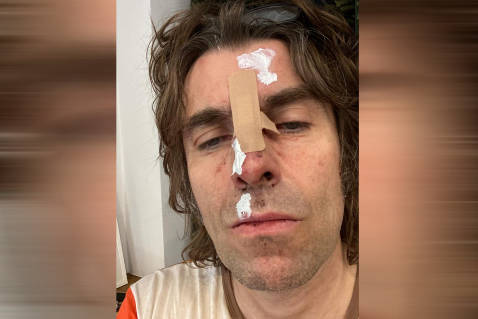 Gallagher wurde bei dem Sturz offenbar heftig erwischt.