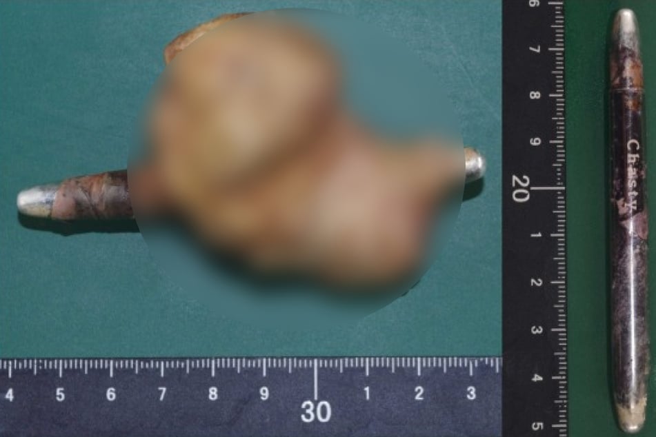 Bei der Obduktion des Toten wurde ein Kajalstift aus Metall gefunden, um den sich ein großer Blasenstein gebildet hatte.