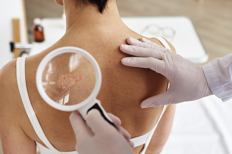 AOK PLUS gibt Tipps zur Vermeidung von Hautkrebsrisiken