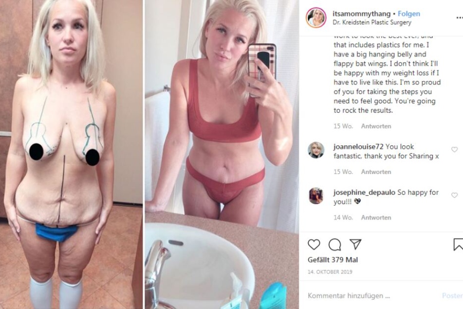 Kelsey Bonas vor (links) und nach der Brust- und Bauchstraffung.