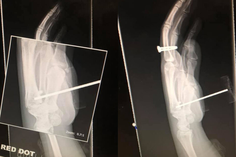 Beim Röntgen wurde klar: Der Metallstab hatte sich bis in den Knochen gebohrt.