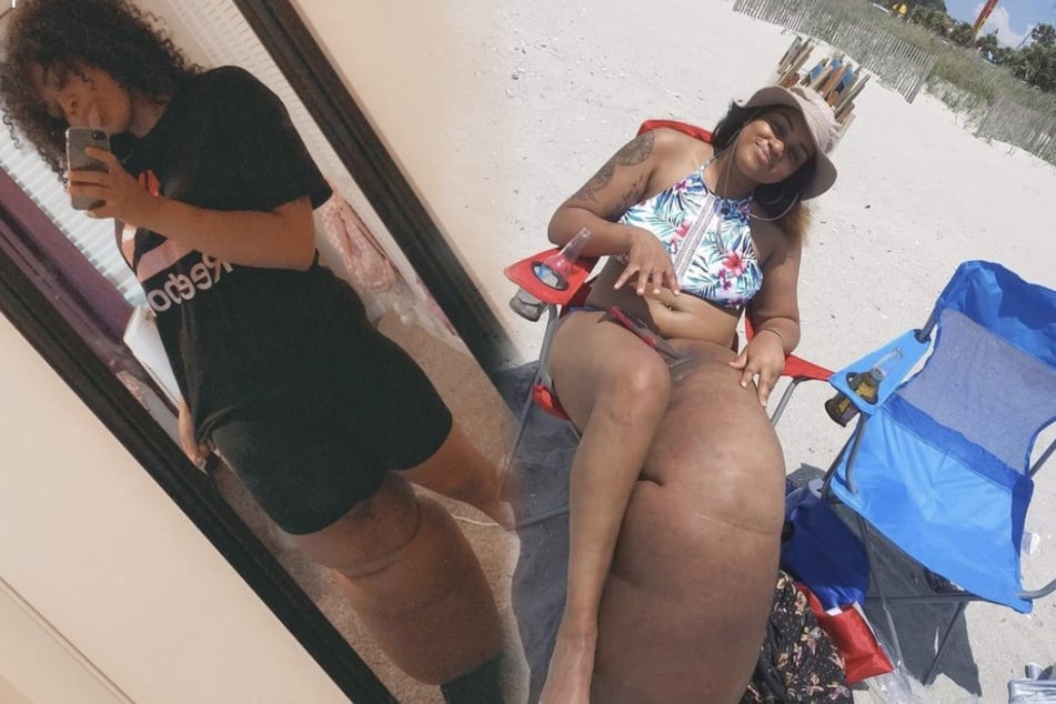 Inspiring model overcomes a disease causing her leg to weigh 100 pounds