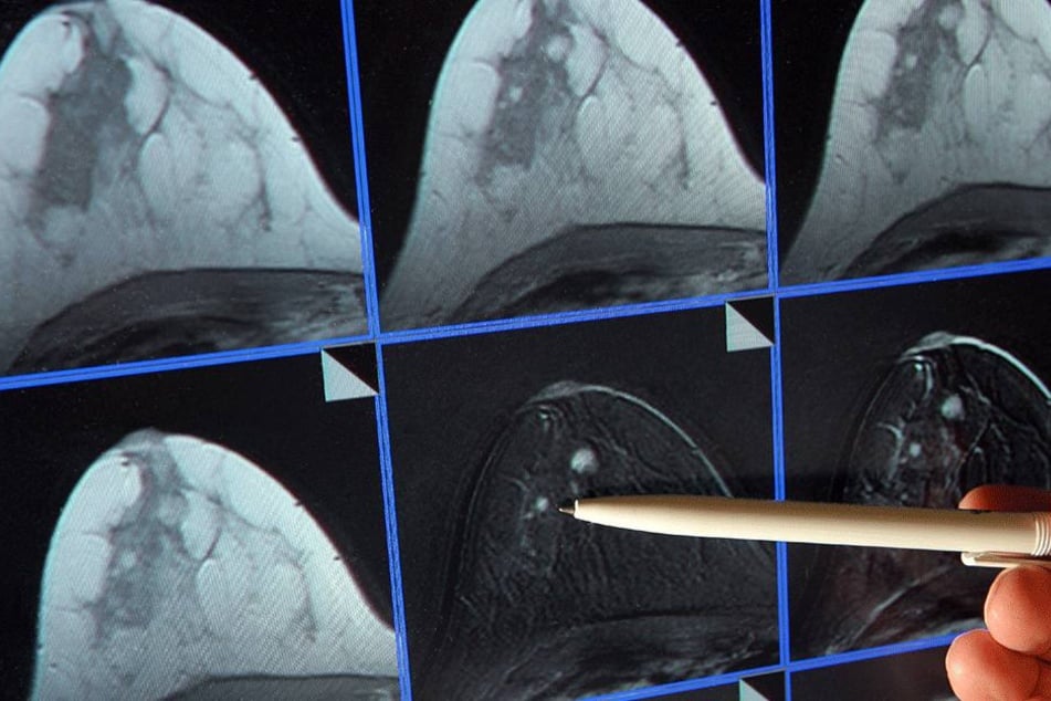 Blick auf die Bildschirmdarstellung einer Magnetresonanz-(MR)-Mammographie. Deutlich sichtbar ein winziger Tumor bei einer Patientin. Brustkrebs gilt als häufigste Krebserkrankung bei Frauen.