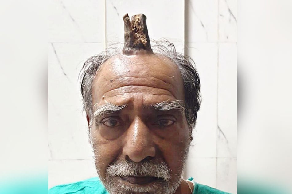 Shyam Lal Yadav (4) aus Indien mit Horn auf dem Kopf.