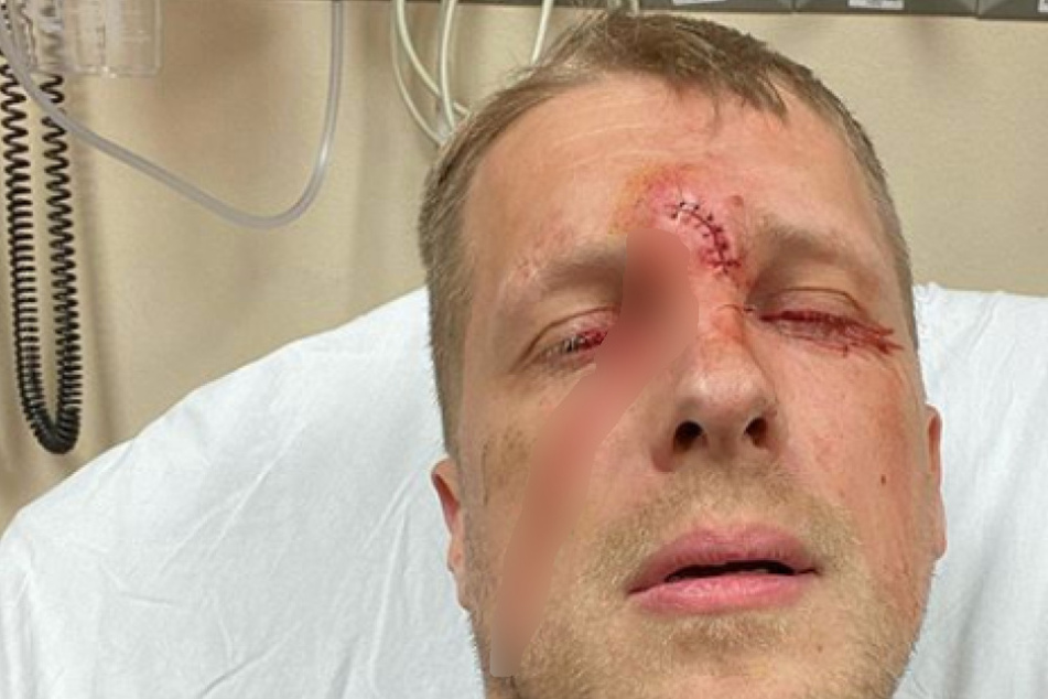 Oliver Pocher verletzt sich bei Dreharbeiten