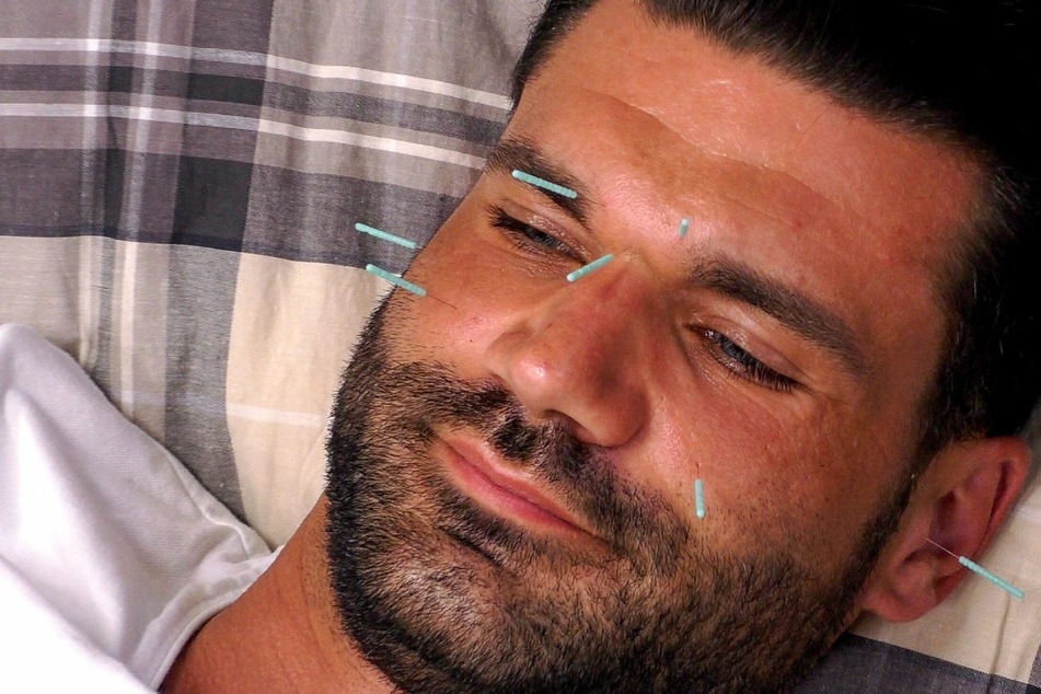 Mike Cees-Monballijn (34) lässt sich zum Stressabbau Akupunktur-Nadeln ins Gesicht stechen...