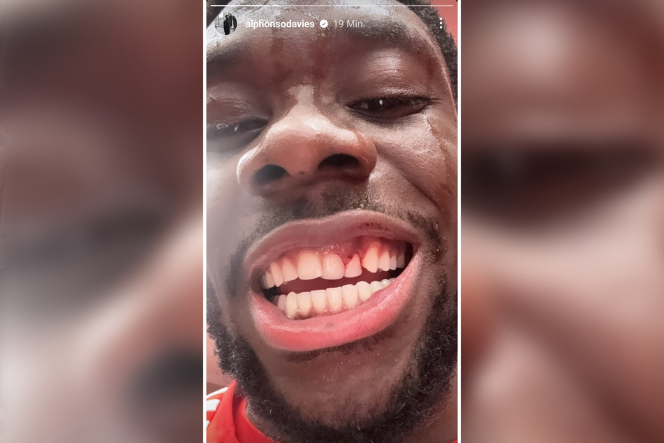 Alphonso Davies (23) präsentierte seine angeschlagenen Zähne nach dem Spiel auf Instagram.