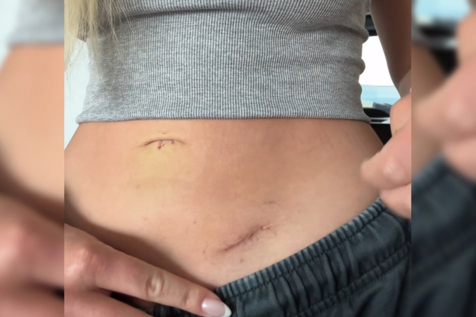 Die 25-Jährige zeigte ihren Followern auch die Narben, die sie von der Operation davongetragen hatte.