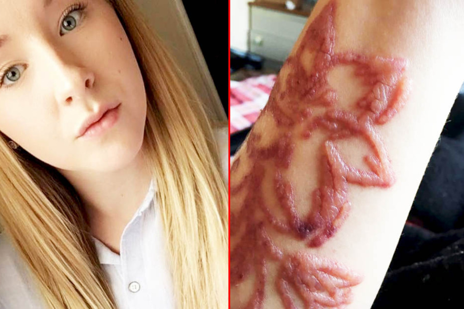 Schock-Fotos: 20-Jährige warnt vor Henna-Tattoos