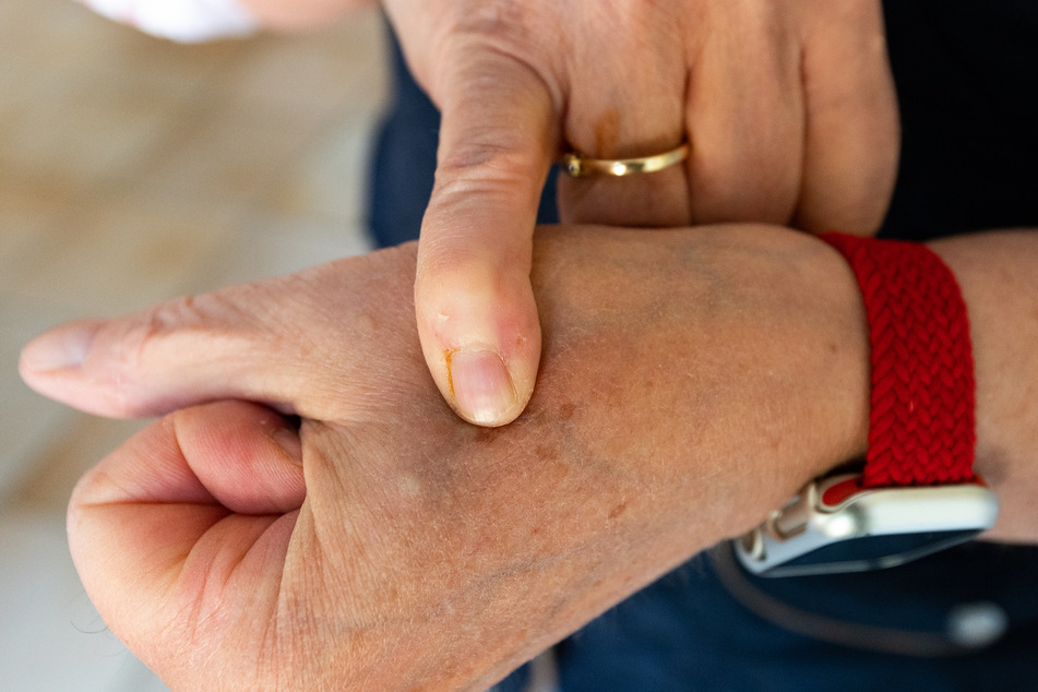 Juliane von der Ohe (60) zeigt auf einen ihrer Chips in der Hand. Zwei Reiskorn große Implantate liegen knapp unter der Haut jeder Hand zwischen Daumen und Zeigefinger.