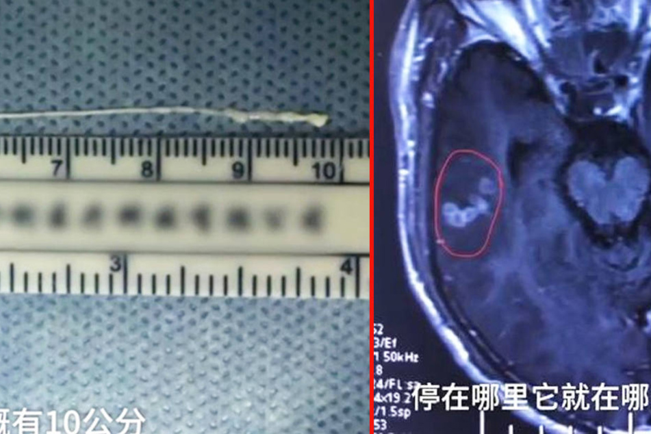 Ärzte operieren lebendigen Bandwurm aus Gehirn eines Mannes