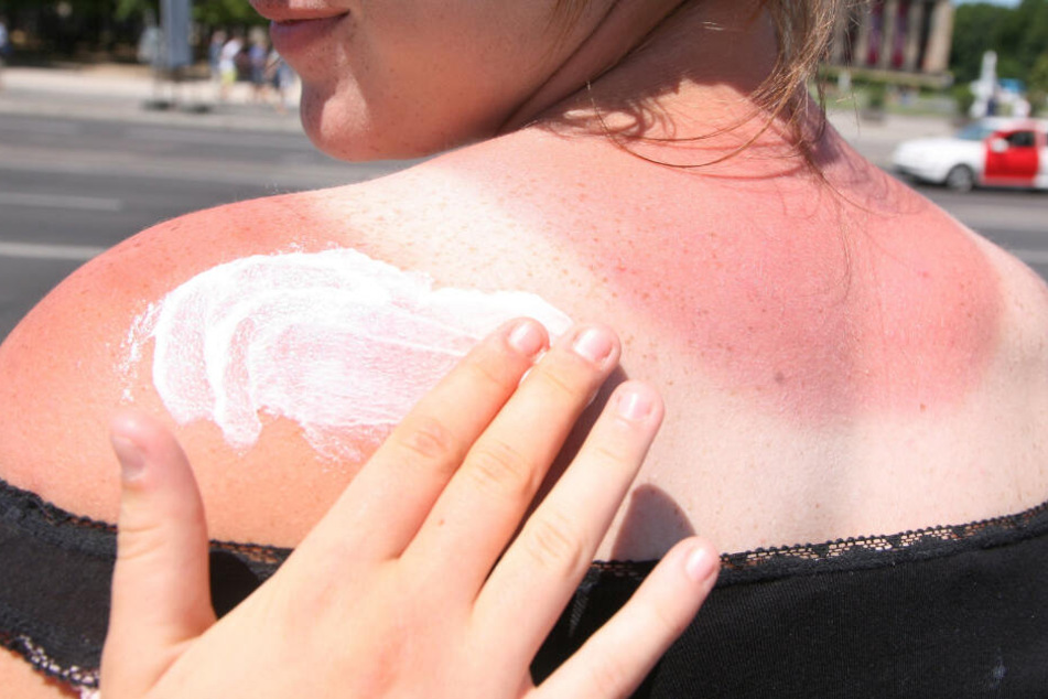 Sonnenbrand erhöht das Hautkrebsrisiko. (Symbolbild)