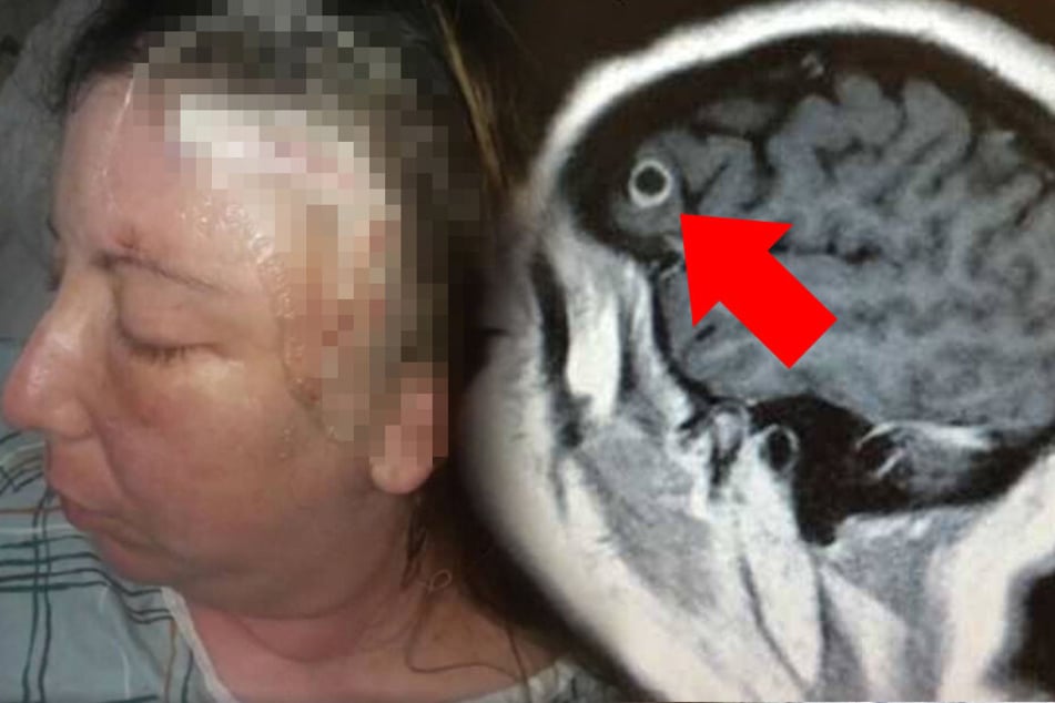 Rachel nach der Operation (links). Ein Scan zeigt das Objekt in ihrem Hirn.