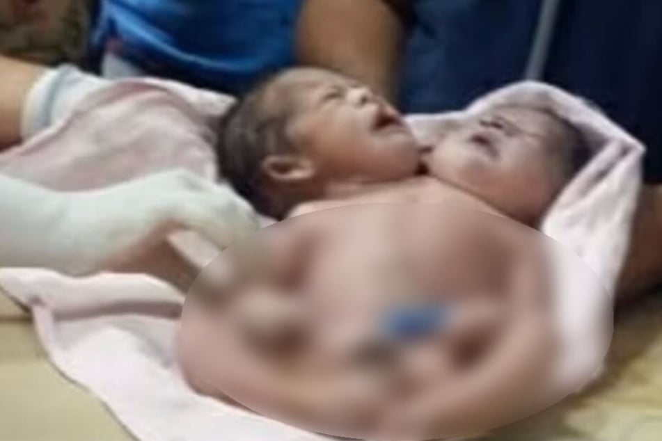 Baby kommt mit zwei Köpfen und drei Armen zur Welt