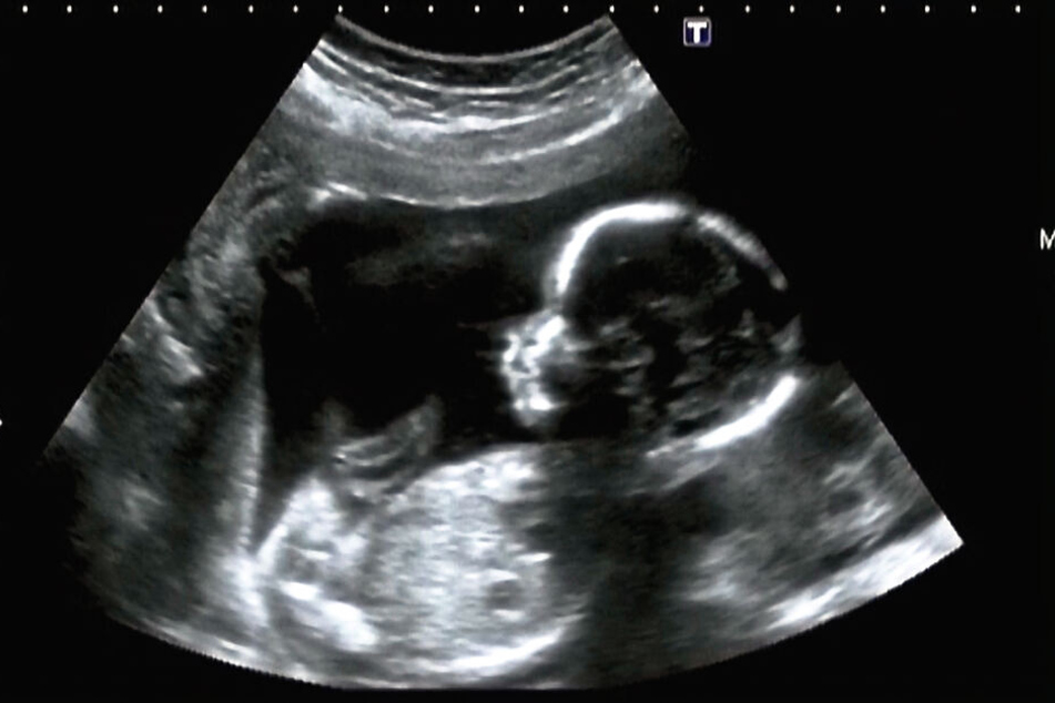 Ein Ultraschallbild eines Fötus im Mutterleib.