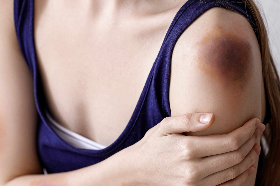 Bei einer jungen Frau in der Schweiz wurde nach der Biss-Attacke ein riesiger Bluterguss festgestellt. (Symbolbild)