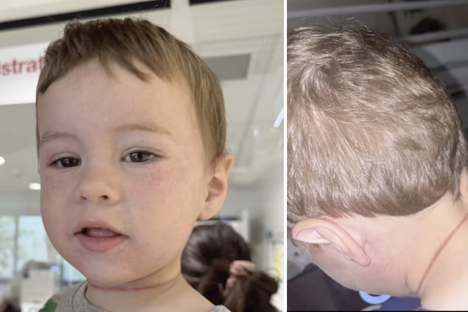 Der Einjährige war durch die Haare seiner Mutter fast stranguliert worden.