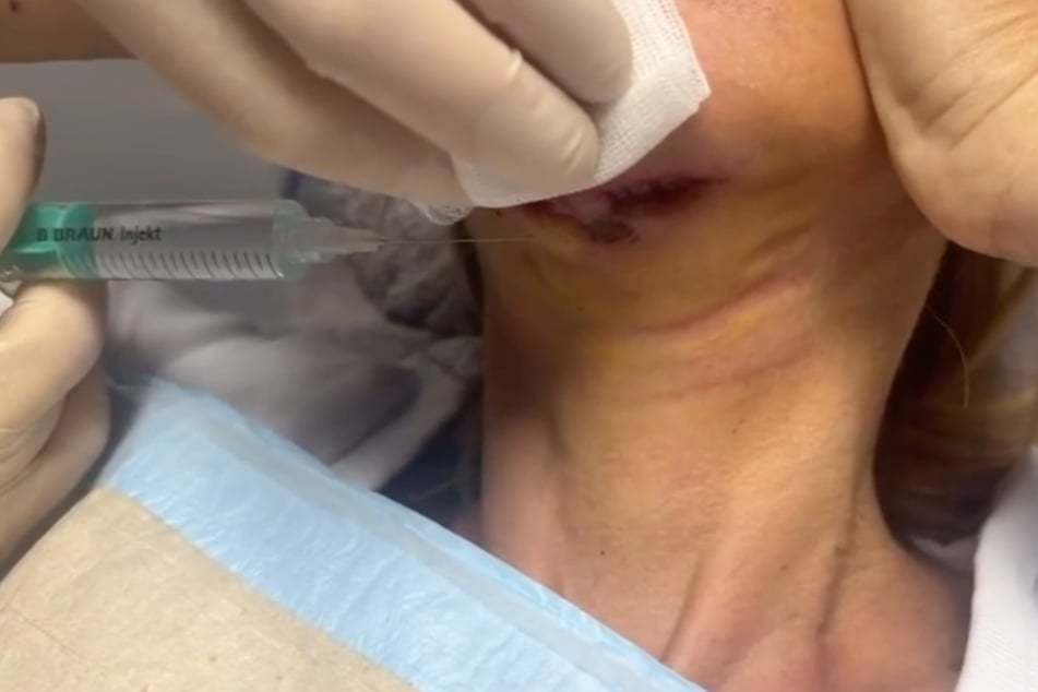 Carmen Geiss teilte am Sonntag ein emotionales Video ihrer Schnittwunde auf Instagram.