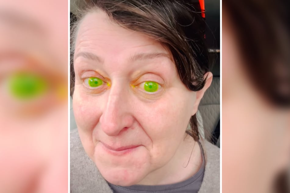 Trudno uwierzyć: po rutynowej wizycie u okulisty oczy Margerity Wargoli z Irlandii nagle zabłysły intensywnym, toksycznym zielonym.