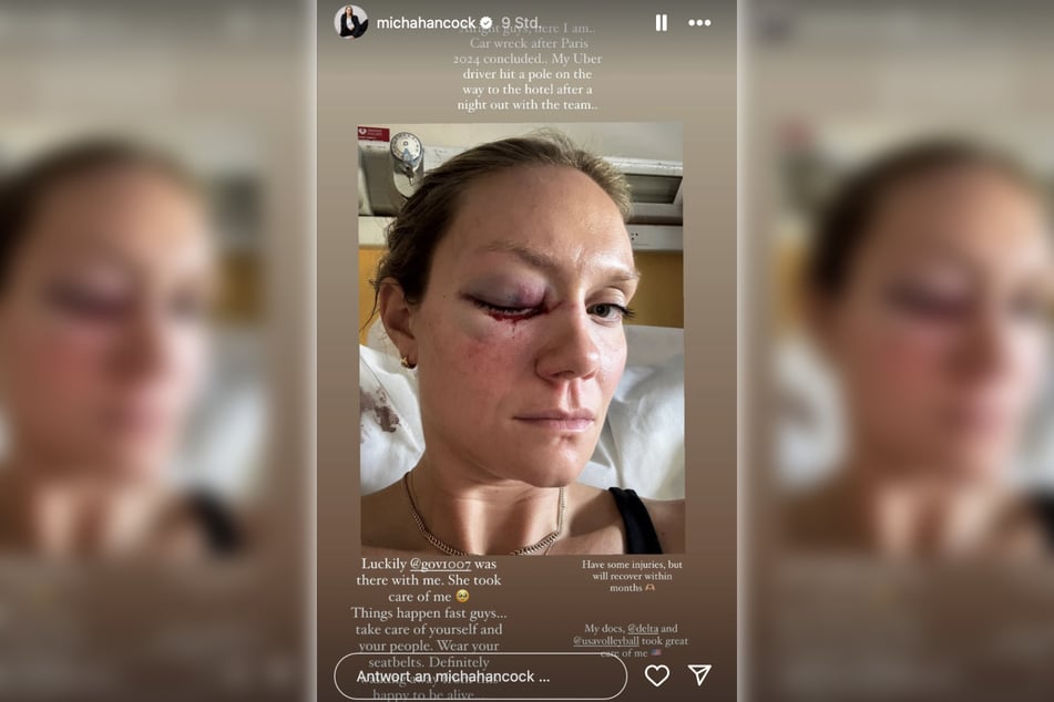 US-Volleyballerin Micha Hancock (31) kam bei einem Verkehrsunfall mit einem blauen Auge davon.