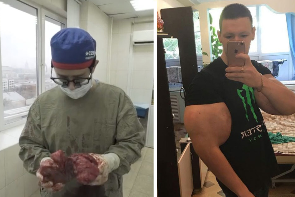 A surgeon removes 3 lbs of dead muscle mass from Kirill Tereshin's arms.