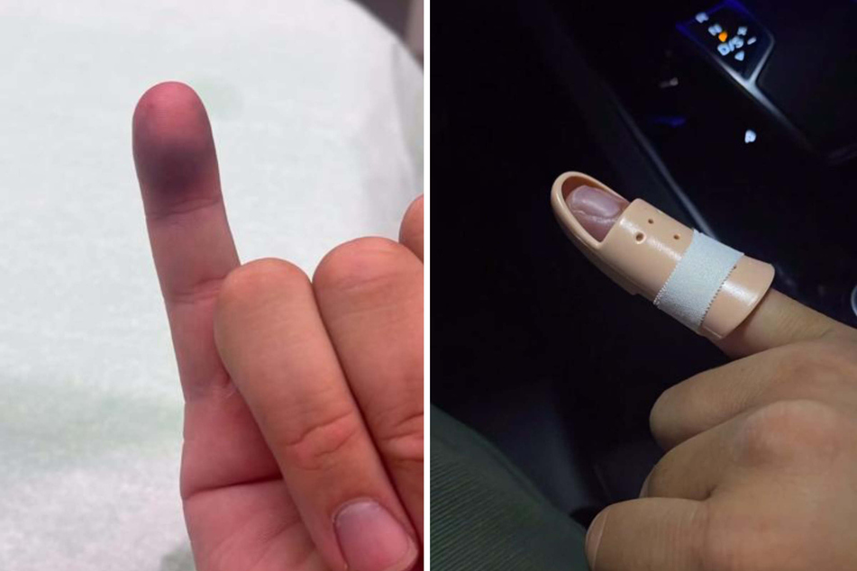 Flo verließ die Klinik schließlich mit einer Schiene an dem betroffenen Finger.