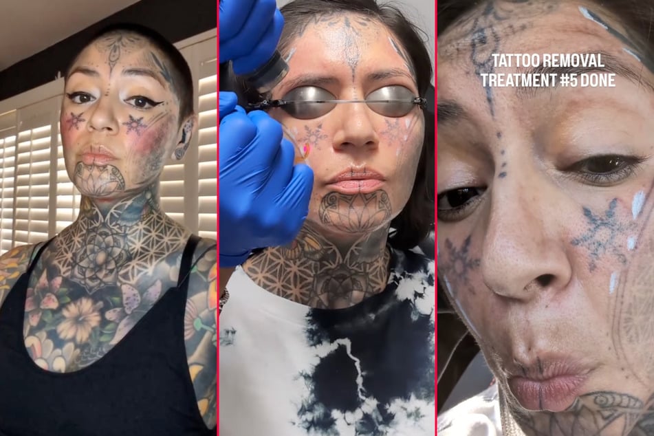 Ink addict undergoes dramatic face tattoo removal: "Feels like walking on hot coals"