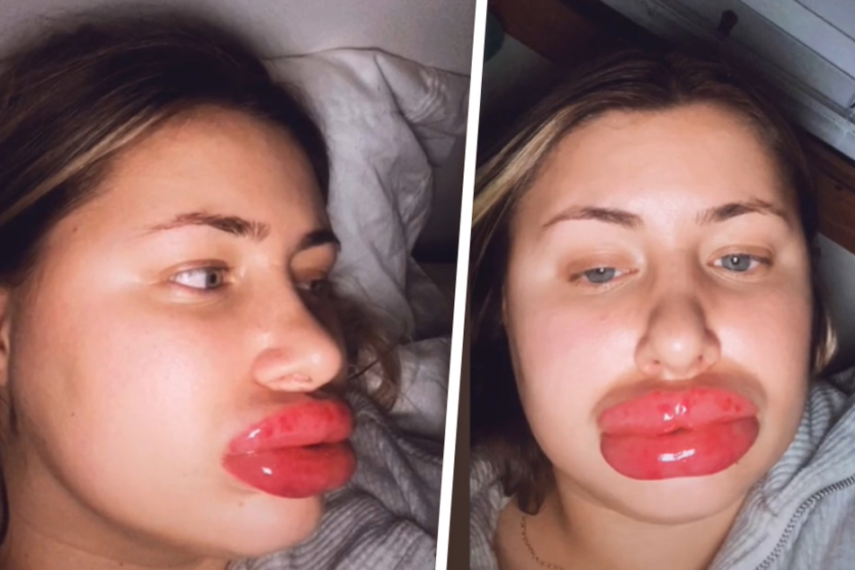 Frau lässt sich Lippen aufspritzen: Eine Stunde später erlebt sie böse Überraschung!