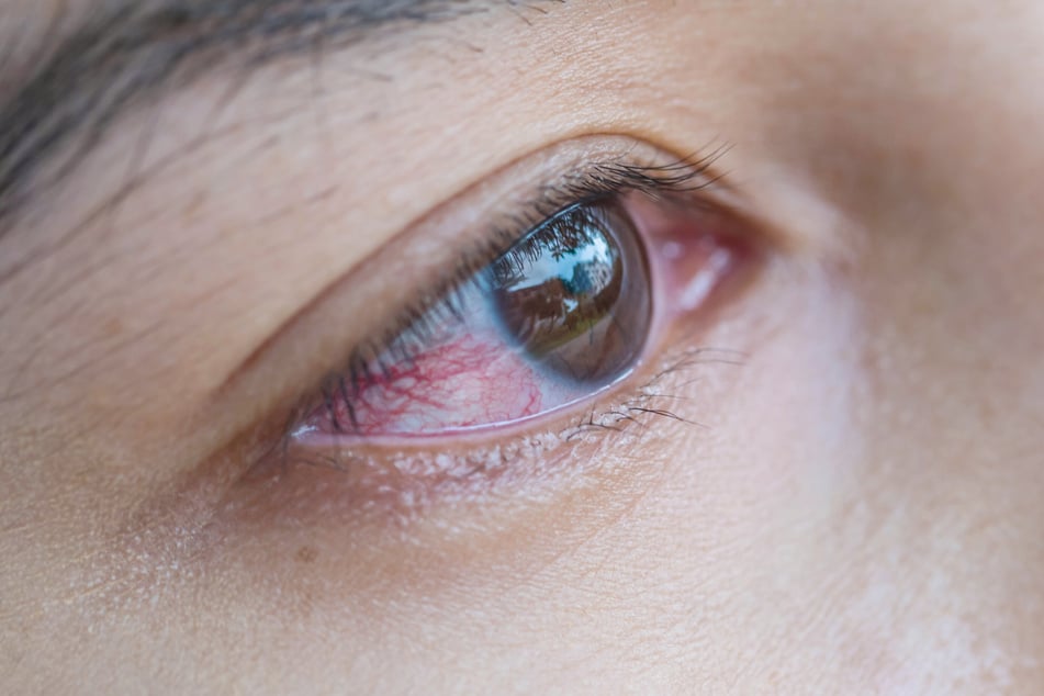 Kratzer auf der Hornhaut sind mit bloßem Auge nicht zu erkennen und können zu schmerzhaften Entzündungen führen. (Symbolfoto)